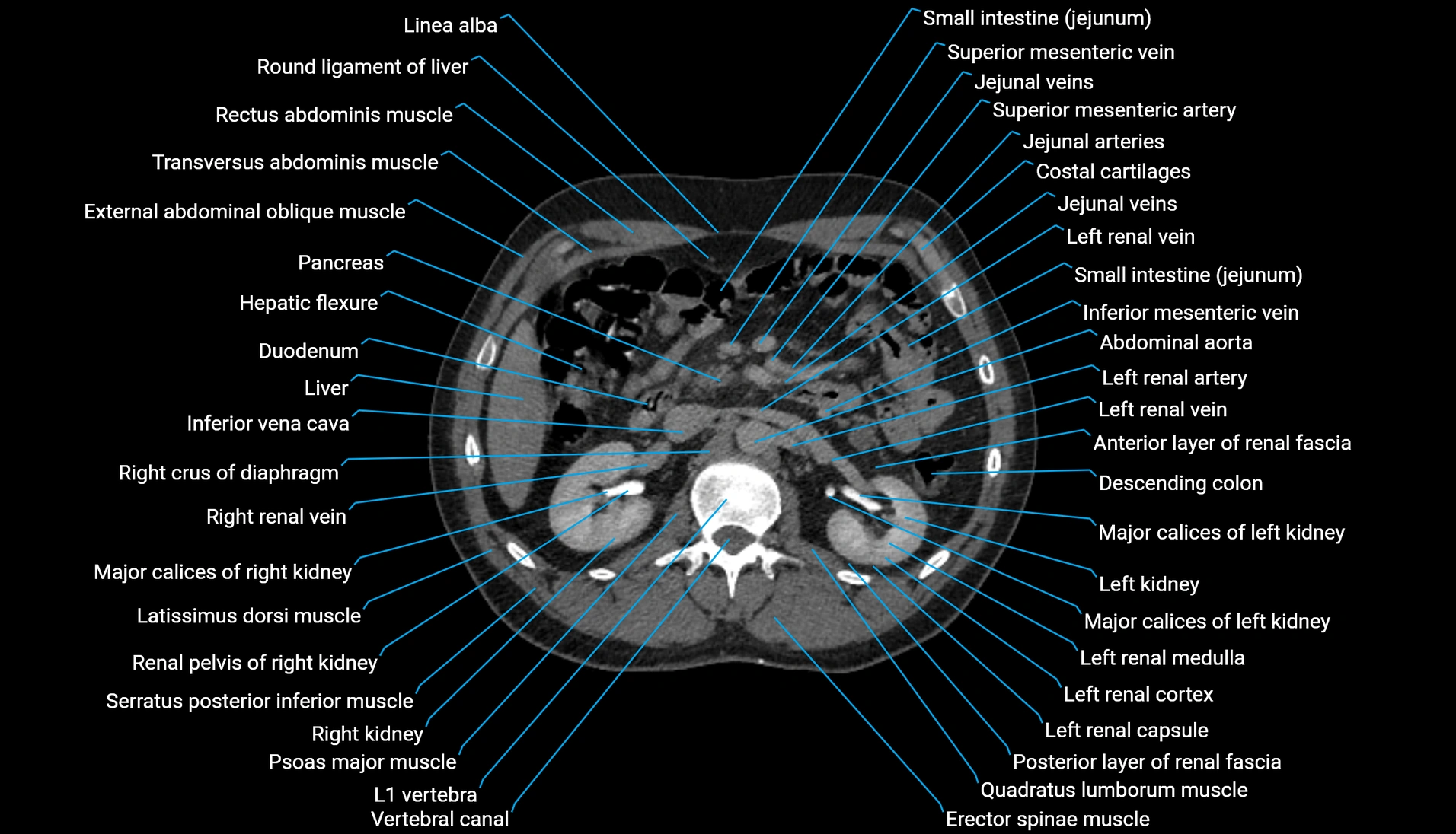 CT urogram axial cross sectional anatomy  labelled radiology image-00101.webp